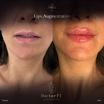 Lips Augmentation