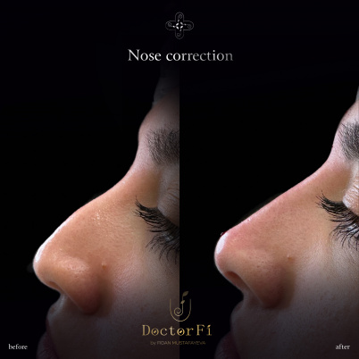 Nose Correction